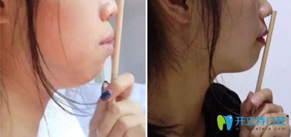 齙牙矯正前和矯正一年后的對比效果圖 齙牙矯正前和矯正一年后的對比效果圖