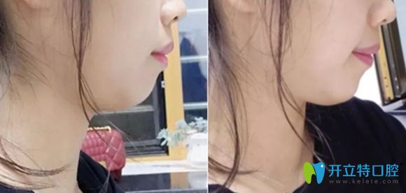 我的牙性加骨性齙牙戴金屬牙套矯正一年半后的效果圖 我的牙性加骨性齙牙戴金屬牙套矯正一年半后的效果圖