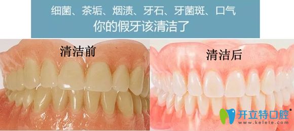 做好假牙清潔可有效避免活動(dòng)義齒戴久了特別臭的尷尬呦!