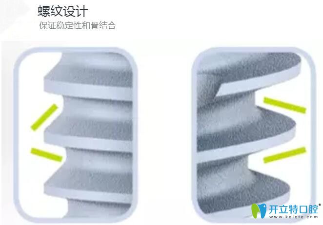 法國(guó)安卓健種植體表面螺紋設(shè)計(jì)