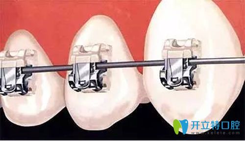 做牙齒矯正時(shí)牙套中鋼絲起的作用可千萬(wàn)別小瞧了!