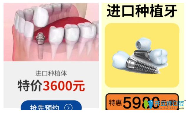 正夫口腔其他種植體價格圖 正夫口腔其他種植體價格圖