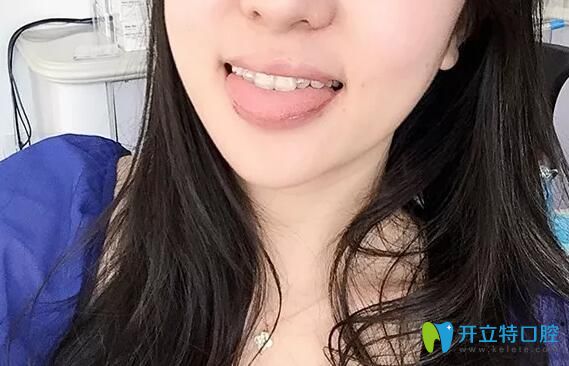在深圳韋博口腔做齙牙矯正1年半效果 在深圳韋博口腔做齙牙矯正1年半效果