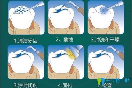 窩溝封閉的過(guò)程圖解