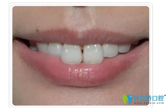 王黨紅主任告訴大家：牙齒矯正回導(dǎo)致“黑三角”是真是假