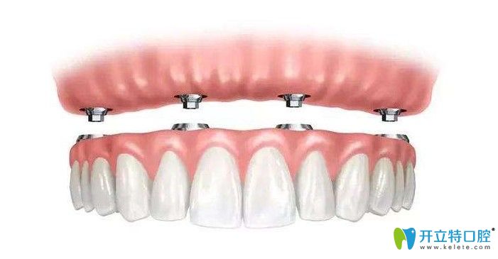 德韓口腔的All-on-4技術(shù)圖