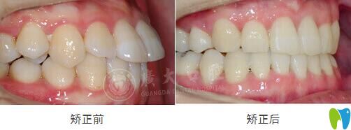 門牙前突在廣州廣大口腔做GA精準數(shù)字化矯正效果