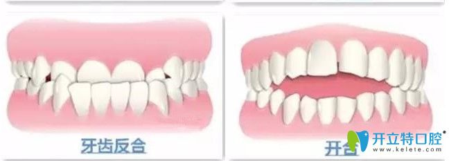牙齒地包天和開合圖示