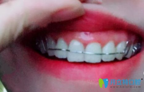 從隱形牙套轉(zhuǎn)入保持器階段