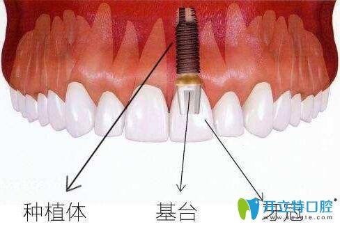 純干貨:種植牙全瓷基臺和純鈦基臺材料哪個好?價格差多少錢