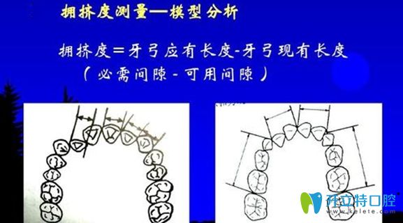 牙弓的測(cè)量示意圖