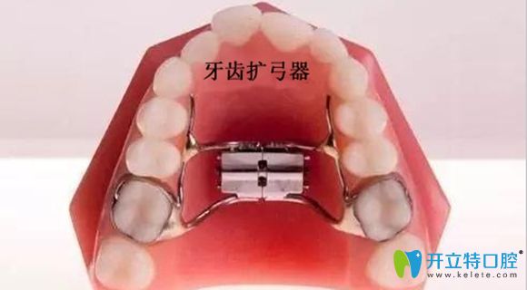 牙齒擴(kuò)弓器展示圖