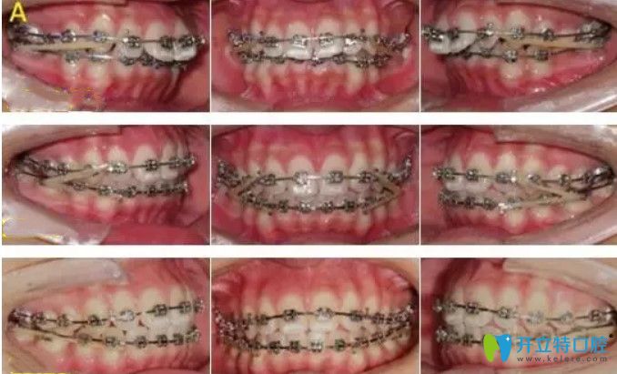 一位47歲大姐來談她使用全同步帶狀弓矯正牙齒的感受