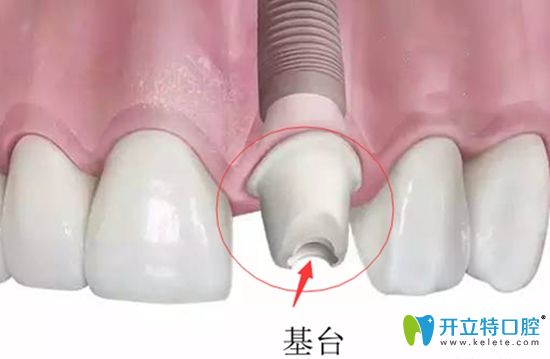想弄清種植牙基臺是什么?安裝基臺疼不疼?戳進來看看就知道