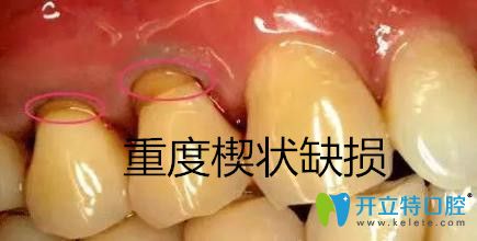 重度牙齒楔狀缺損