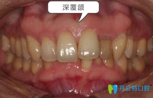 深覆合牙齒癥狀圖