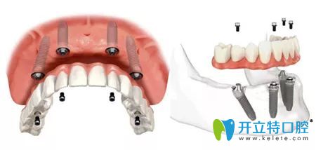 北京維樂口腔ALLON4種植牙