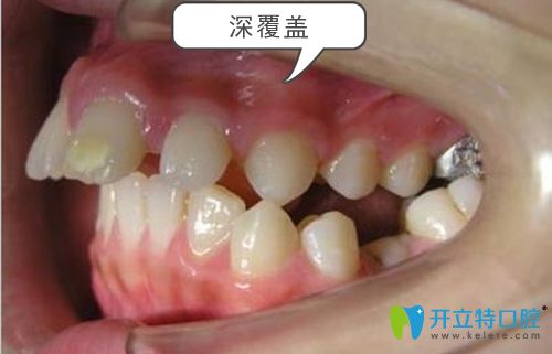 深覆蓋牙齒癥狀圖