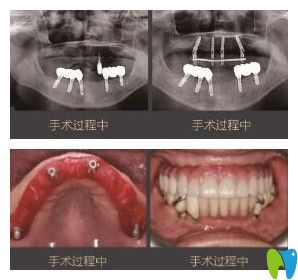 老爸在北京維樂口腔做種植牙過程中