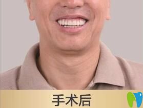 老爸在北京維樂口腔做種植牙后