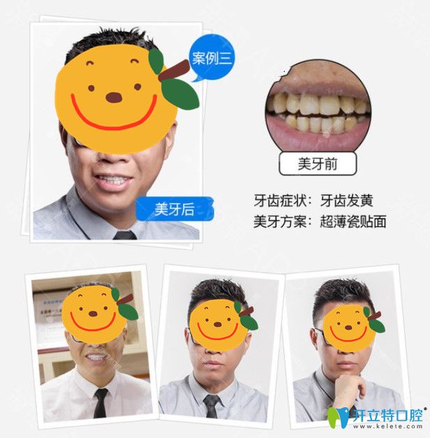 廣州瓷貼面哪家做的好？在曙光口腔做了牙貼面顧客用效果來說話