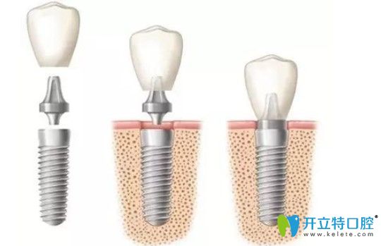 瑞士iti親水種植體可適用于糖尿病種植牙