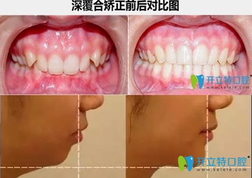 深覆頜矯正<span style=