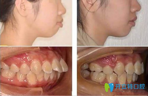 深覆蓋矯正后臉型變化圖