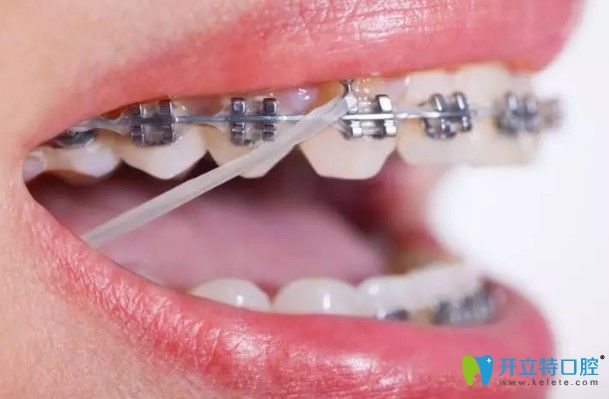 張慧貞醫(yī)生科普：正畸橡皮圈有什么作用？