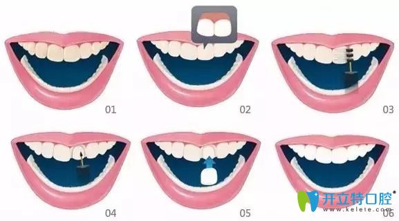 備受追捧的牙齒貼面材料選全瓷、硬質(zhì)和樹脂貼面哪個好