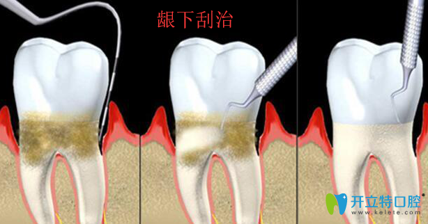 牙周袋齦下刮治術(shù)