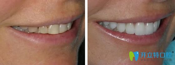 德國義獲嘉瓷貼面修復效果圖