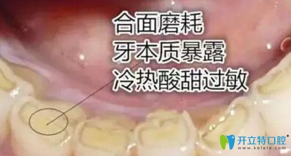 王迪醫(yī)生告訴大家：長期用單側(cè)牙齒咀嚼食物有什么危害