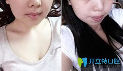 三思后,在廣州廣大口腔讓何錦泉醫(yī)生做了正頜聯(lián)合正畸手術(shù)