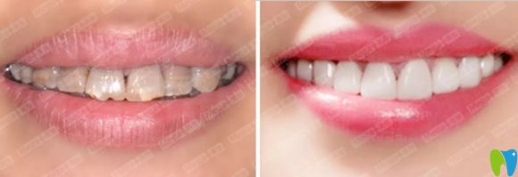 美加超薄瓷貼面修復效果圖