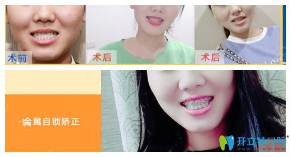 地包天MM在亞韓矯正牙齒后收獲愛情