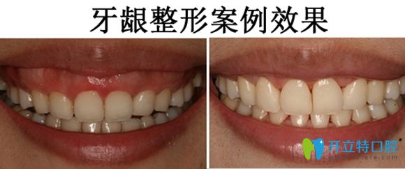 牙齦整形案例效果圖