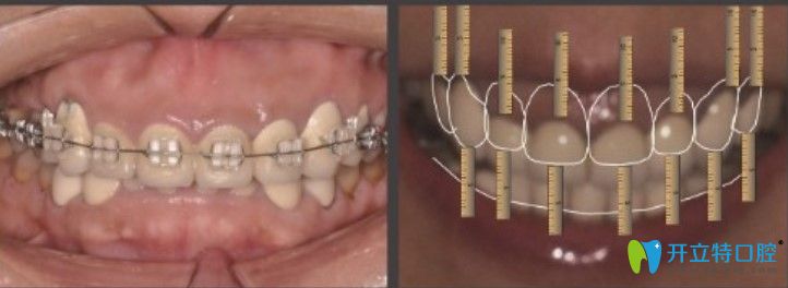 王女士牙齒矯正+修復過程圖示 王女士牙齒矯正+修復過程圖示