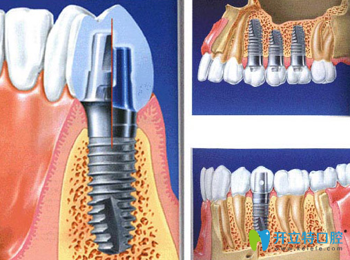 微創(chuàng)種植牙多少錢