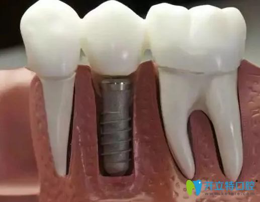 種牙需要多長(zhǎng)時(shí)間