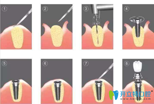 種植牙過(guò)程