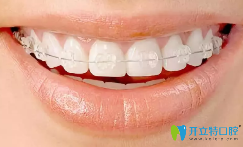 半隱形牙齒矯正明顯嗎？得從隱形和半隱形矯正的區(qū)別說(shuō)起