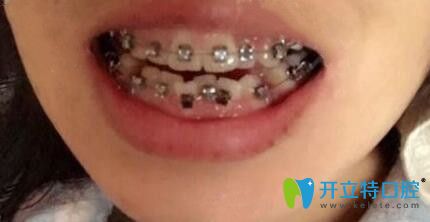 我在中諾口腔剛戴牙套的照片 我在中諾口腔剛戴牙套的照片