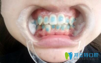 我在石家莊中諾口腔做牙齒矯正粘牙套 我在石家莊中諾口腔做牙齒矯正粘牙套