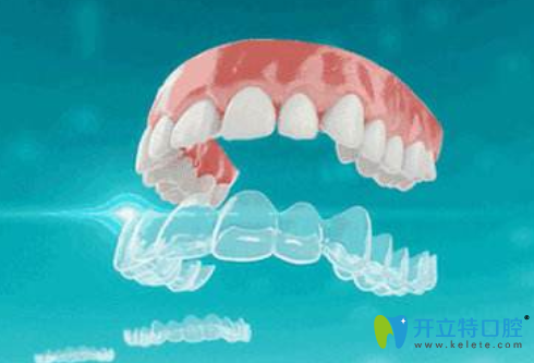 正雅和美立刻哪個好？從兩個牙套的價格及優(yōu)缺點看出區(qū)別