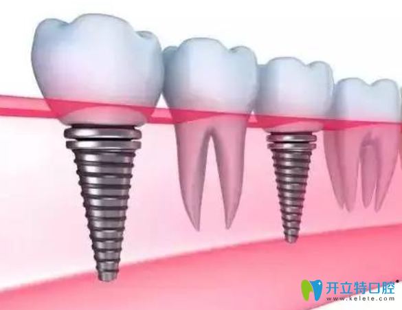 韓國登騰種植牙很差嗎？