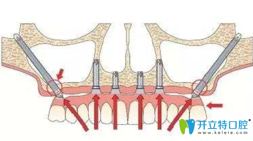 穿顴種植手術(shù)圖片