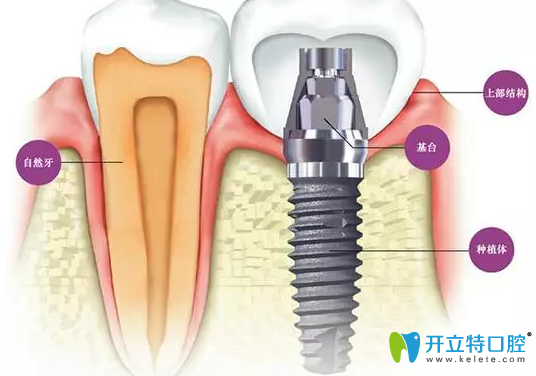 牙槽骨小于幾毫米不能種牙？怎么判斷牙槽骨薄,這篇就夠了