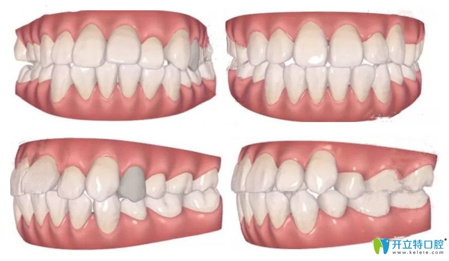 公開我的隱適美矯正齙牙記錄！我?guī)а捞?~12月變化圖明顯不