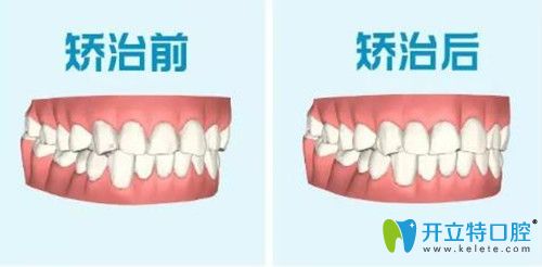 達(dá)芬奇隱形矯正前后對(duì)比